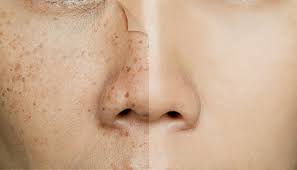 Tratamientos Efectivos para Manchas, Cicatrices y Arrugas